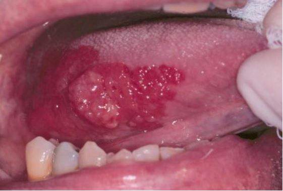 Oral Cancer. Mouth Cancer - Oral Cancer Screening Melbourne CBD MELBOURNE