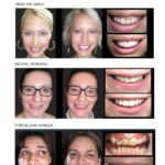 Cosmetic Dentistry Smile Makeovers Before and After Photos