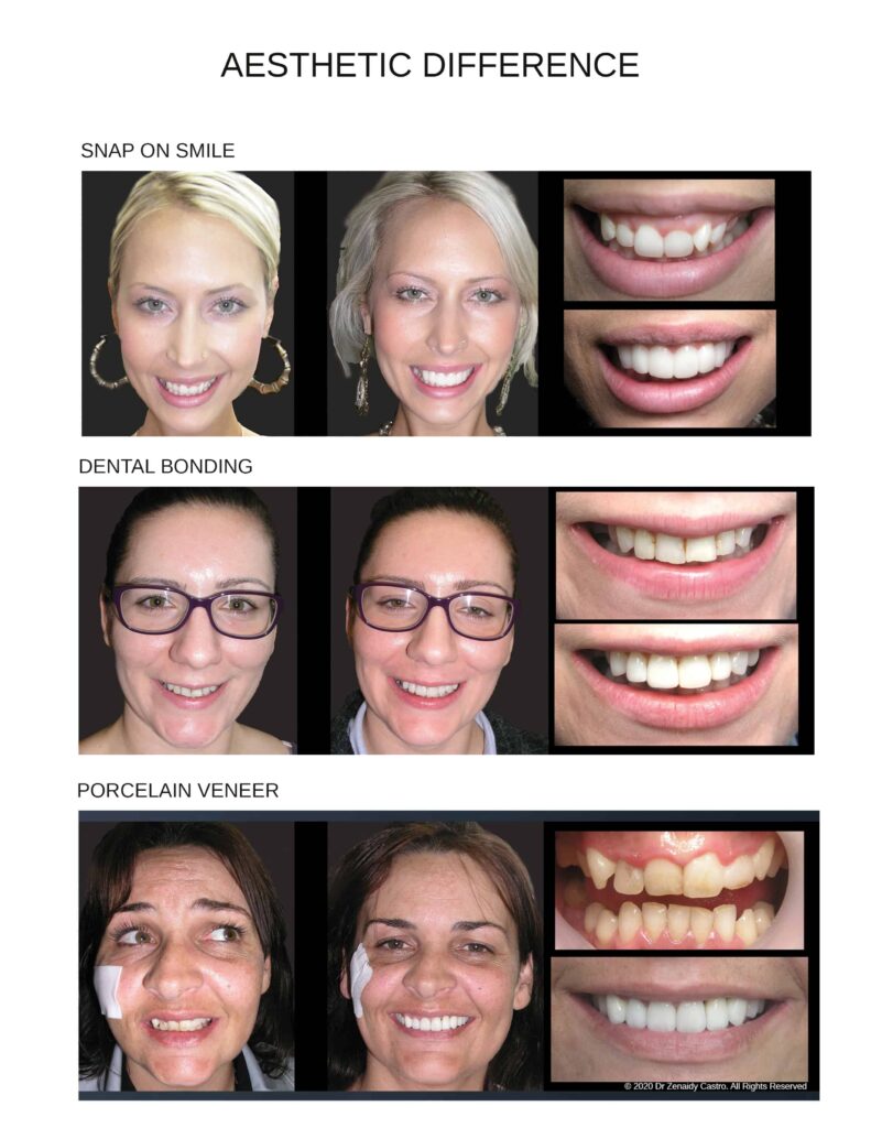 Cosmetic Dentistry Smile Makeovers Before and After Photos