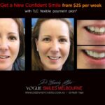 AFFORDABLE-COSMETIC-DENTISTRY-MAKEOVER-WITH-DENTAL-BONDING-MELBOURNE-11.jpg