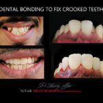 Wanting to Instantly straighten your Crooked teeth
