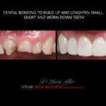 AFFORDABLE-COSMETIC-DENTISTRY-MAKEOVER-WITH-DENTAL-BONDING-MELBOURNE-13.jpg