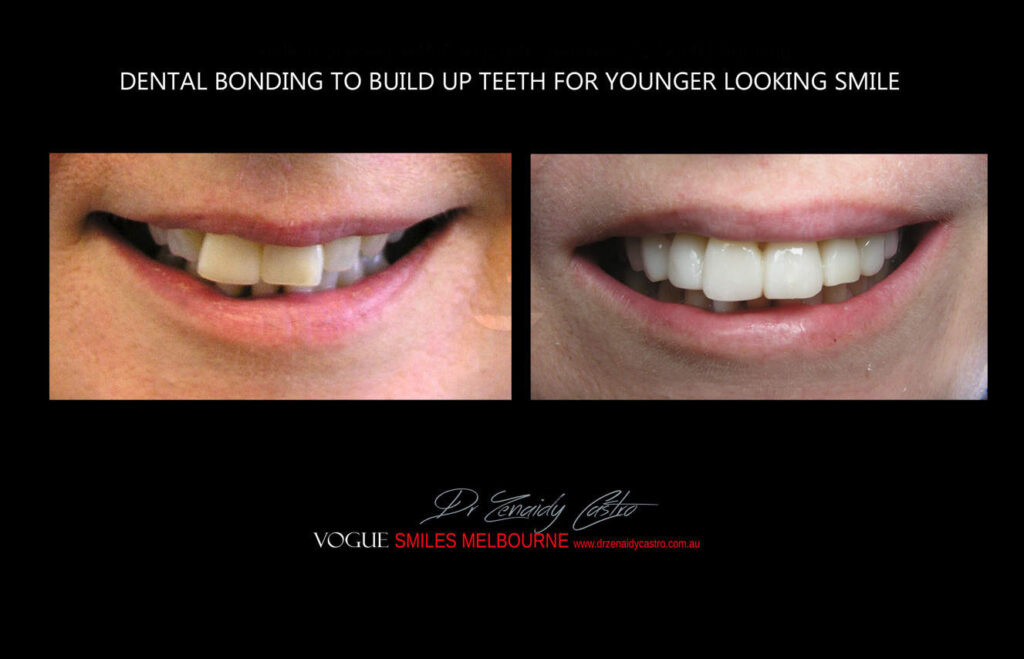 AFFORDABLE-COSMETIC-DENTISTRY-MAKEOVER-WITH-DENTAL-BONDING-MELBOURNE-15.jpg