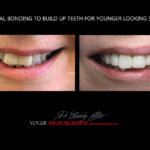 AFFORDABLE-COSMETIC-DENTISTRY-MAKEOVER-WITH-DENTAL-BONDING-MELBOURNE-15.jpg