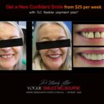 AFFORDABLE-COSMETIC-DENTISTRY-MAKEOVER-WITH-DENTAL-BONDING-MELBOURNE-18.jpg