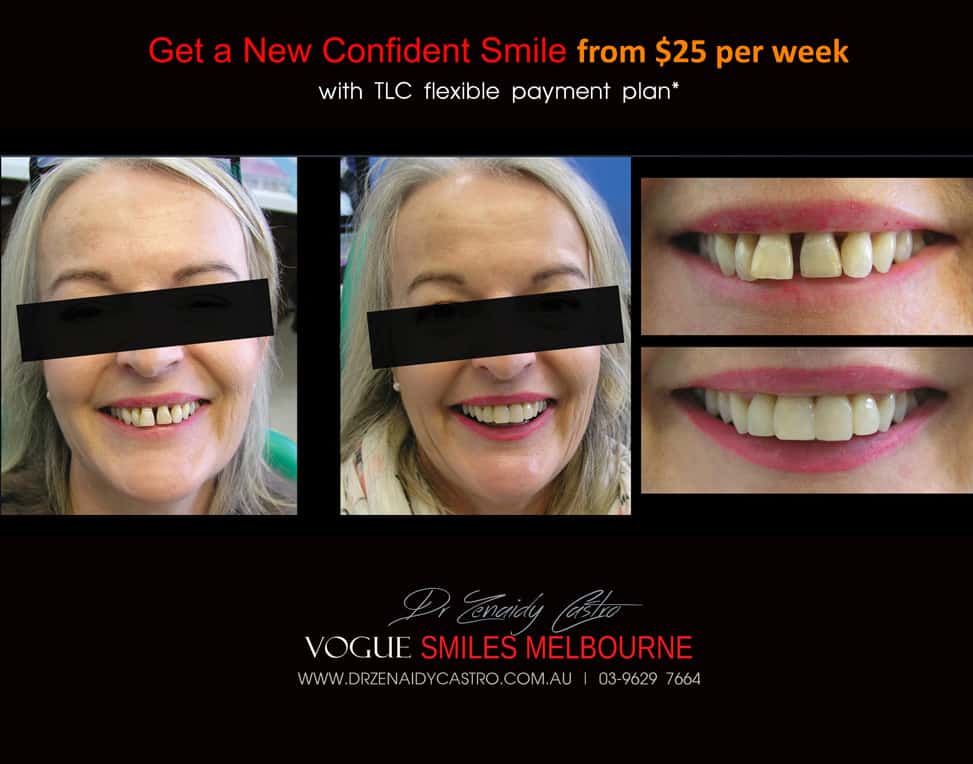 AFFORDABLE-COSMETIC-DENTISTRY-MAKEOVER-WITH-DENTAL-BONDING-MELBOURNE-18.jpg