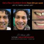 AFFORDABLE-COSMETIC-DENTISTRY-MAKEOVER-WITH-DENTAL-BONDING-MELBOURNE-19.jpg