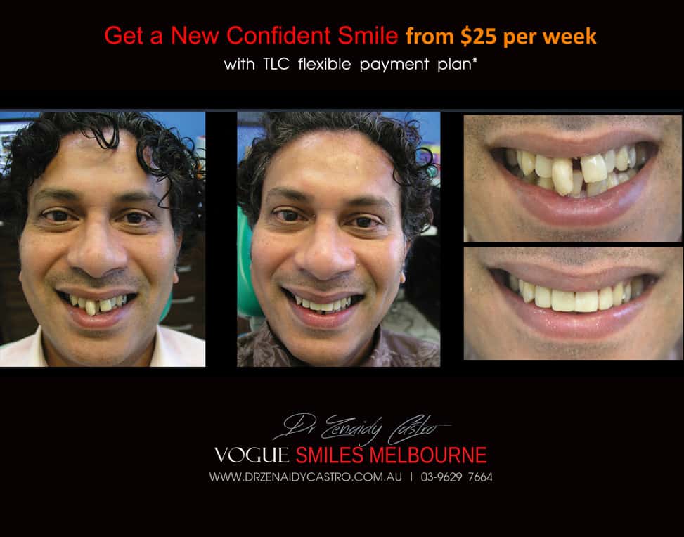 AFFORDABLE-COSMETIC-DENTISTRY-MAKEOVER-WITH-DENTAL-BONDING-MELBOURNE-19.jpg