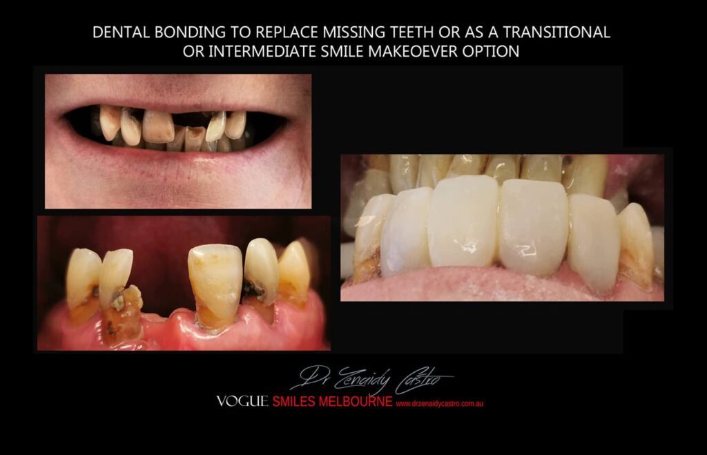 AFFORDABLE COSMETIC DENTISTRY MAKEOVER WITH DENTAL BONDING MELBOURNE