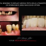 AFFORDABLE COSMETIC DENTISTRY MAKEOVER WITH DENTAL BONDING MELBOURNE