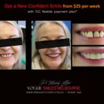 AFFORDABLE-COSMETIC-DENTISTRY-MAKEOVER-WITH-DENTAL-BONDING-MELBOURNE-20.jpg