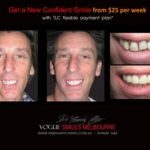 AFFORDABLE-COSMETIC-DENTISTRY-MAKEOVER-WITH-DENTAL-BONDING-MELBOURNE-21.jpg