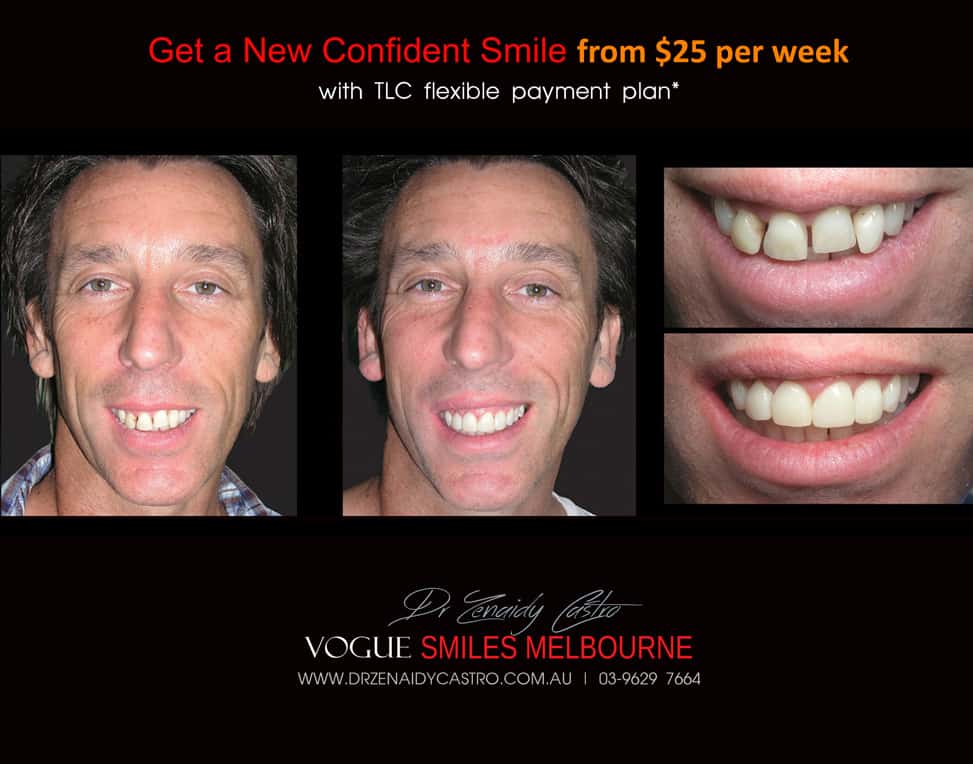 AFFORDABLE-COSMETIC-DENTISTRY-MAKEOVER-WITH-DENTAL-BONDING-MELBOURNE-21.jpg