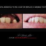 AFFORDABLE-COSMETIC-DENTISTRY-MAKEOVER-WITH-DENTAL-BONDING-MELBOURNE-22.jpg