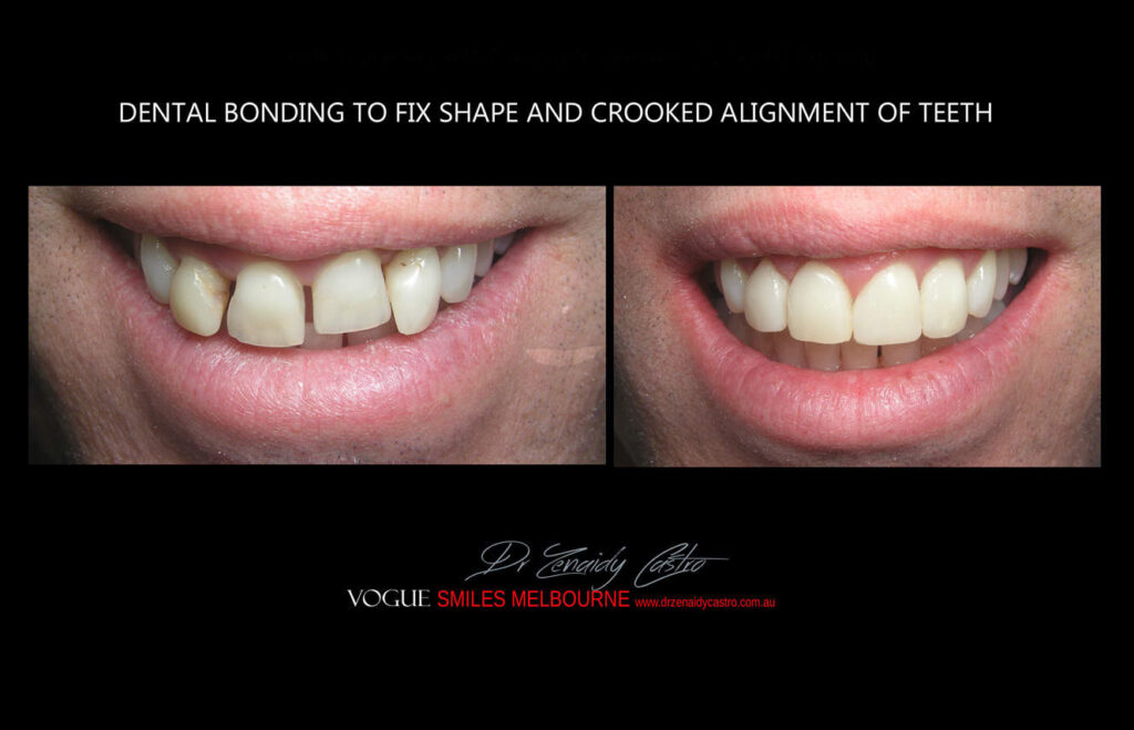 AFFORDABLE-COSMETIC-DENTISTRY-MAKEOVER-WITH-DENTAL-BONDING-MELBOURNE-24.jpg