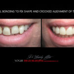 AFFORDABLE-COSMETIC-DENTISTRY-MAKEOVER-WITH-DENTAL-BONDING-MELBOURNE-24.jpg