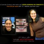 AFFORDABLE-COSMETIC-DENTISTRY-MAKEOVER-WITH-DENTAL-BONDING-MELBOURNE-31-scaled.jpg