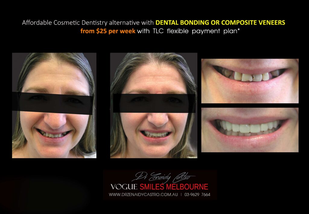 AFFORDABLE-COSMETIC-DENTISTRY-MAKEOVER-WITH-DENTAL-BONDING-MELBOURNE-32-scaled.jpg