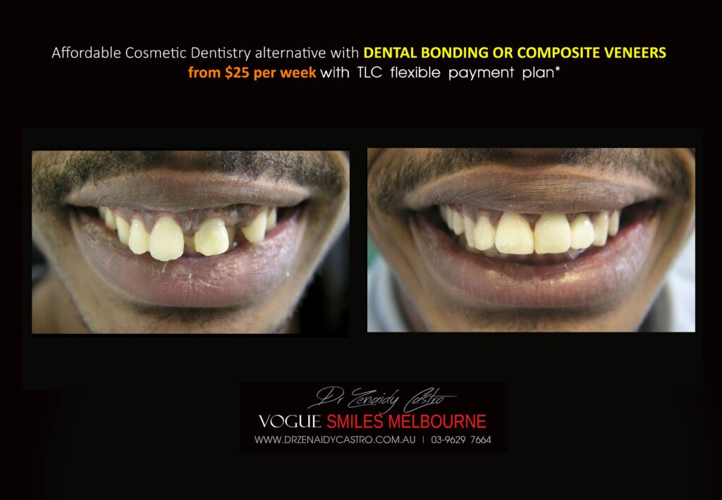 AFFORDABLE-COSMETIC-DENTISTRY-MAKEOVER-WITH-DENTAL-BONDING-MELBOURNE-34-scaled.jpg
