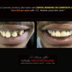 AFFORDABLE-COSMETIC-DENTISTRY-MAKEOVER-WITH-DENTAL-BONDING-MELBOURNE-34-scaled.jpg