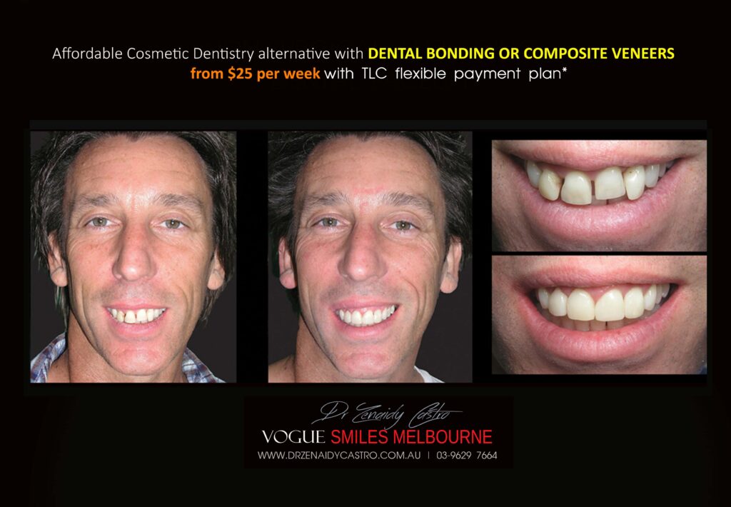 AFFORDABLE-COSMETIC-DENTISTRY-MAKEOVER-WITH-DENTAL-BONDING-MELBOURNE-36-scaled.jpg
