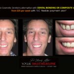 AFFORDABLE-COSMETIC-DENTISTRY-MAKEOVER-WITH-DENTAL-BONDING-MELBOURNE-36-scaled.jpg