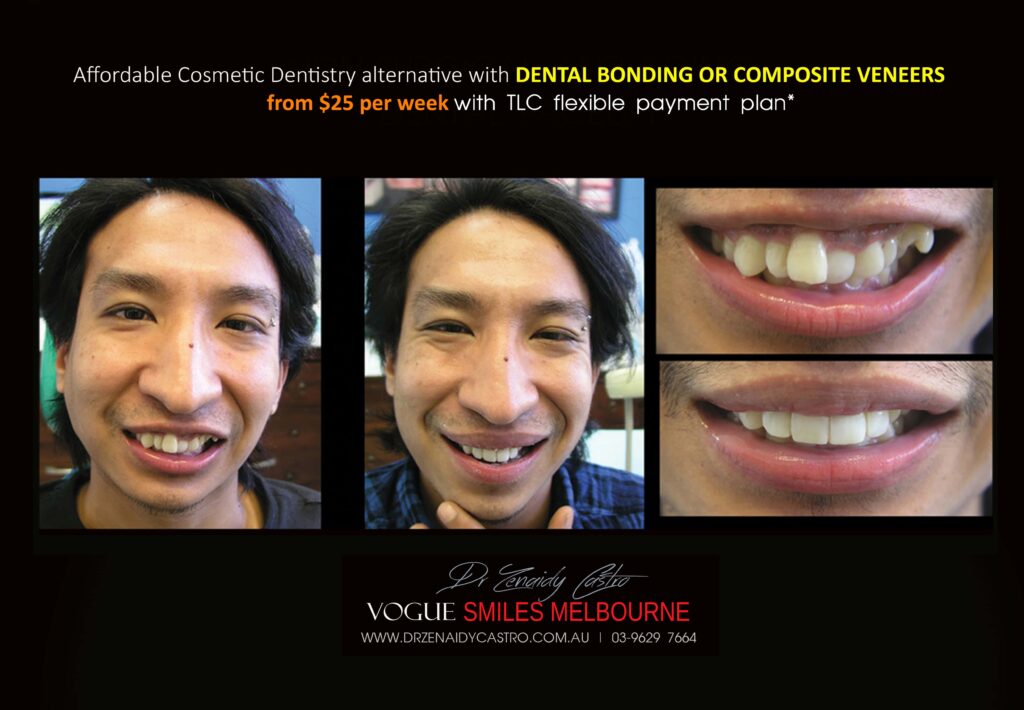 AFFORDABLE-COSMETIC-DENTISTRY-MAKEOVER-WITH-DENTAL-BONDING-MELBOURNE-37-scaled.jpg