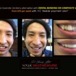 AFFORDABLE-COSMETIC-DENTISTRY-MAKEOVER-WITH-DENTAL-BONDING-MELBOURNE-37-scaled.jpg