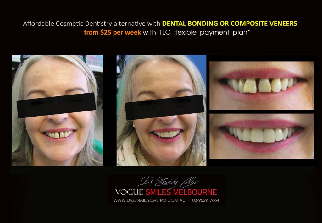 AFFORDABLE-COSMETIC-DENTISTRY-MAKEOVER-WITH-DENTAL-BONDING-MELBOURNE-38-scaled.jpg