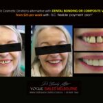 AFFORDABLE-COSMETIC-DENTISTRY-MAKEOVER-WITH-DENTAL-BONDING-MELBOURNE-38-scaled.jpg