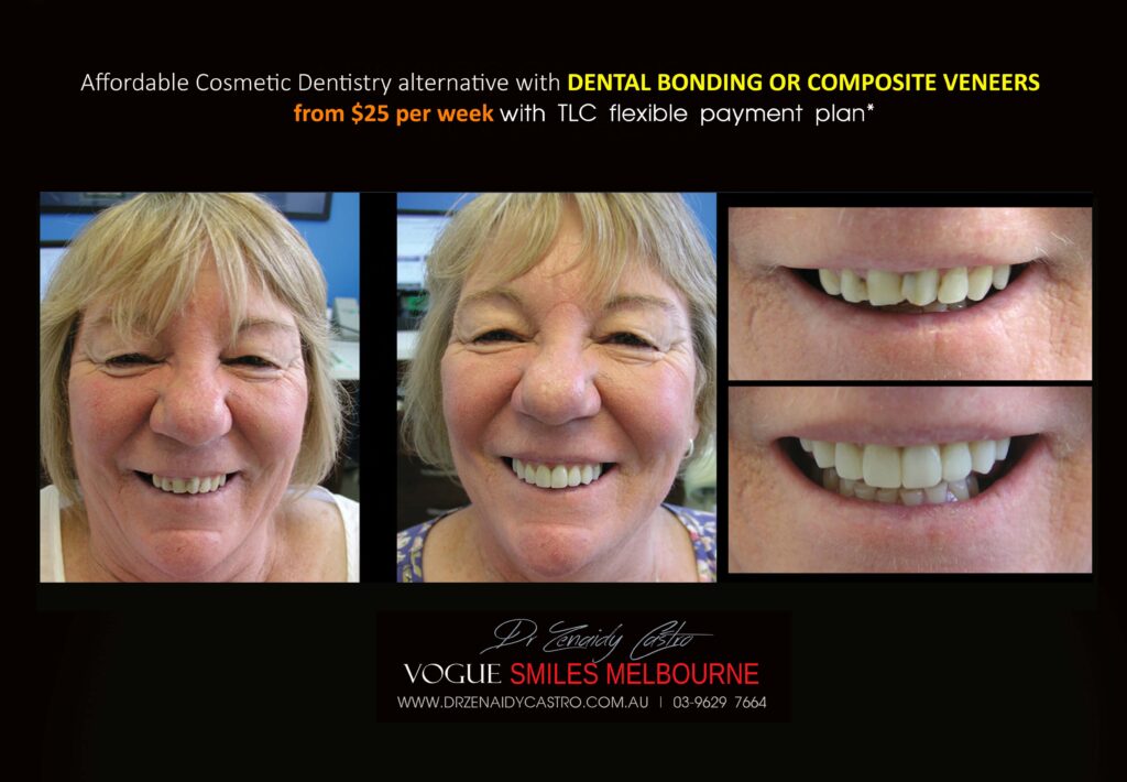 AFFORDABLE-COSMETIC-DENTISTRY-MAKEOVER-WITH-DENTAL-BONDING-MELBOURNE-39-scaled.jpg