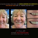 AFFORDABLE-COSMETIC-DENTISTRY-MAKEOVER-WITH-DENTAL-BONDING-MELBOURNE-39-scaled.jpg