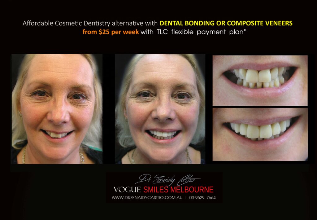 AFFORDABLE-COSMETIC-DENTISTRY-MAKEOVER-WITH-DENTAL-BONDING-MELBOURNE-40-scaled.jpg