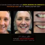 AFFORDABLE-COSMETIC-DENTISTRY-MAKEOVER-WITH-DENTAL-BONDING-MELBOURNE-40-scaled.jpg