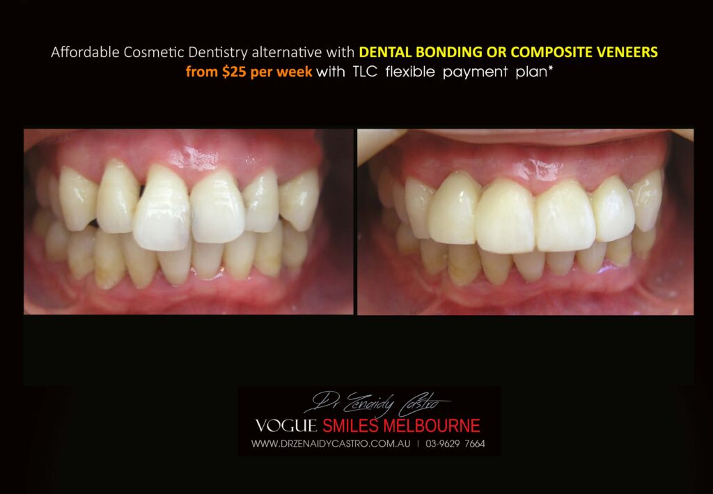 AFFORDABLE-COSMETIC-DENTISTRY-MAKEOVER-WITH-DENTAL-BONDING-MELBOURNE-41-scaled.jpg