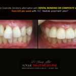 AFFORDABLE-COSMETIC-DENTISTRY-MAKEOVER-WITH-DENTAL-BONDING-MELBOURNE-41-scaled.jpg