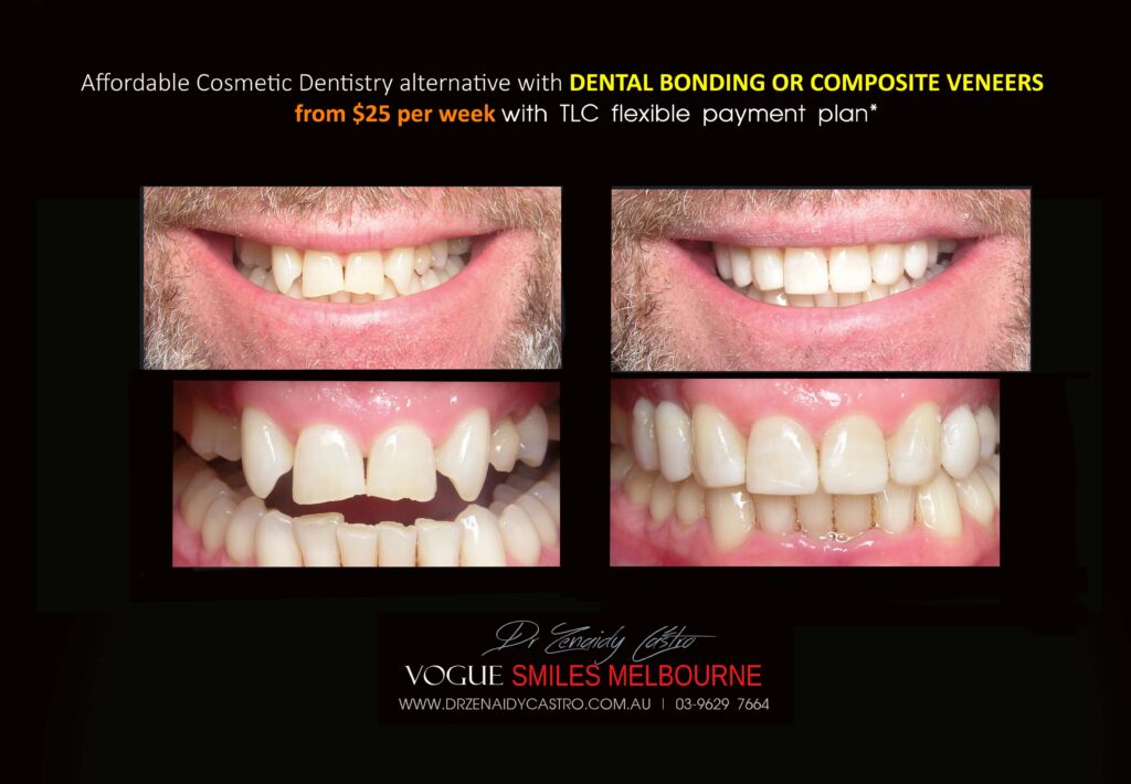 AFFORDABLE-COSMETIC-DENTISTRY-MAKEOVER-WITH-DENTAL-BONDING-MELBOURNE-42-scaled.jpg