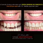 AFFORDABLE-COSMETIC-DENTISTRY-MAKEOVER-WITH-DENTAL-BONDING-MELBOURNE-42-scaled.jpg
