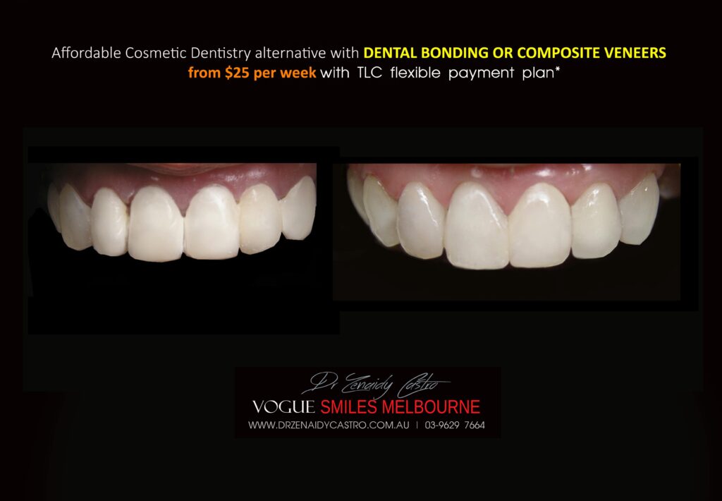 AFFORDABLE-COSMETIC-DENTISTRY-MAKEOVER-WITH-DENTAL-BONDING-MELBOURNE-43-scaled.jpg