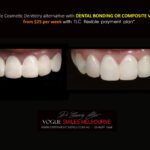 AFFORDABLE-COSMETIC-DENTISTRY-MAKEOVER-WITH-DENTAL-BONDING-MELBOURNE-43-scaled.jpg