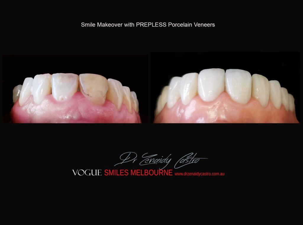 AFFORDABLE-COSMETIC-DENTISTRY-MAKEOVER-WITH-DENTAL-BONDING-MELBOURNE-44.jpg