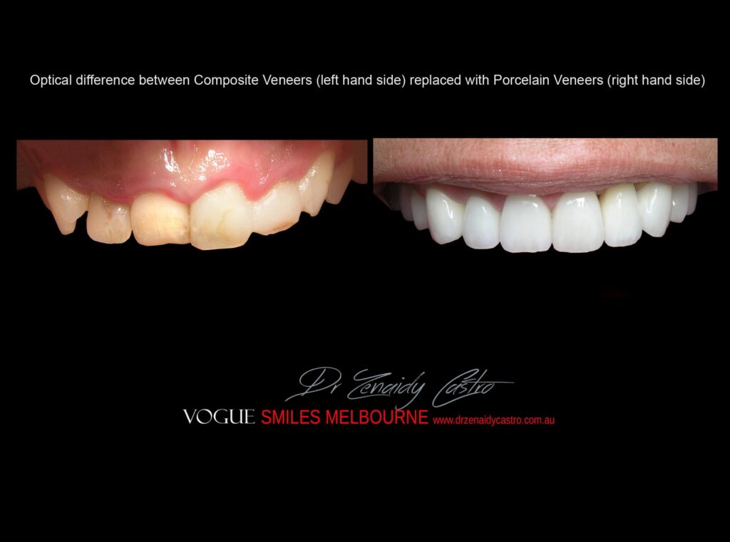 AFFORDABLE-COSMETIC-DENTISTRY-MAKEOVER-WITH-DENTAL-BONDING-MELBOURNE-45.jpg