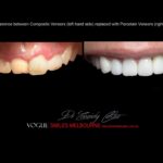 AFFORDABLE-COSMETIC-DENTISTRY-MAKEOVER-WITH-DENTAL-BONDING-MELBOURNE-45.jpg