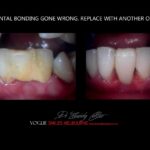 AFFORDABLE-COSMETIC-DENTISTRY-MAKEOVER-WITH-DENTAL-BONDING-MELBOURNE-47.jpg