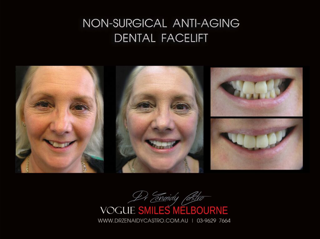 AFFORDABLE-COSMETIC-DENTISTRY-MAKEOVER-WITH-DENTAL-BONDING-MELBOURNE-52-scaled.jpg