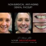 AFFORDABLE-COSMETIC-DENTISTRY-MAKEOVER-WITH-DENTAL-BONDING-MELBOURNE-52-scaled.jpg