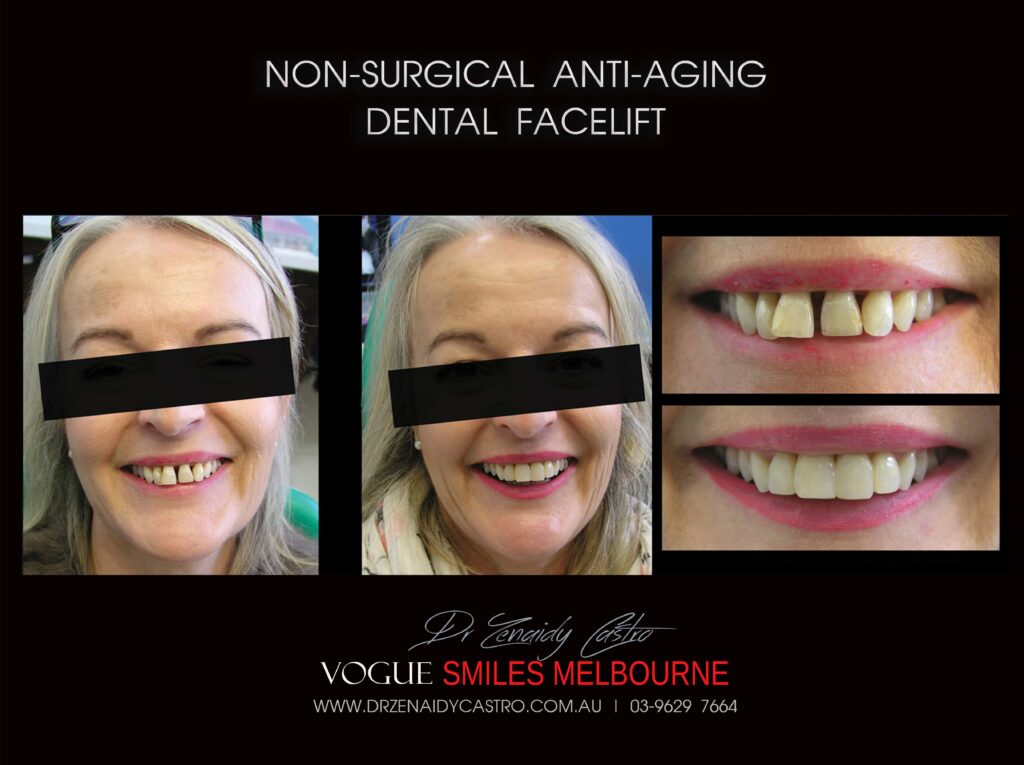 AFFORDABLE-COSMETIC-DENTISTRY-MAKEOVER-WITH-DENTAL-BONDING-MELBOURNE-53-scaled.jpg