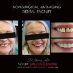 AFFORDABLE-COSMETIC-DENTISTRY-MAKEOVER-WITH-DENTAL-BONDING-MELBOURNE-53-scaled.jpg