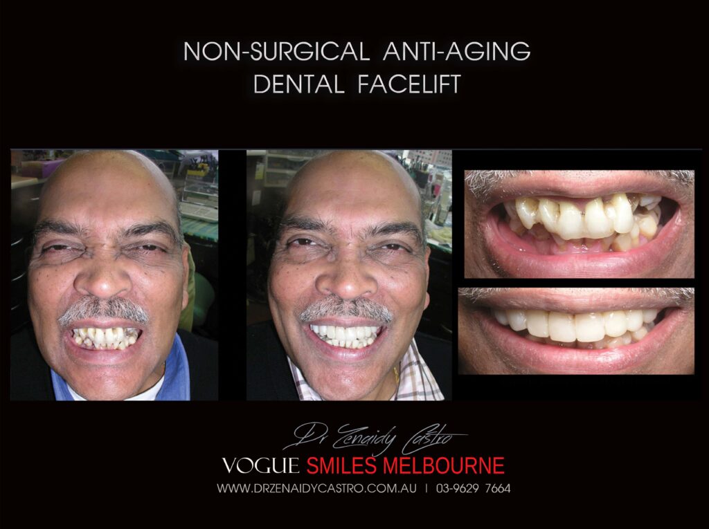 AFFORDABLE-COSMETIC-DENTISTRY-MAKEOVER-WITH-DENTAL-BONDING-MELBOURNE-54-scaled.jpg