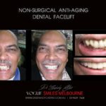 AFFORDABLE-COSMETIC-DENTISTRY-MAKEOVER-WITH-DENTAL-BONDING-MELBOURNE-54-scaled.jpg